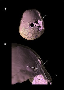 fracture-3d-image