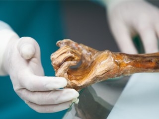 Analisi DNA individuano l’Helicobacter pylori nello stomaco della mummia Ötzi